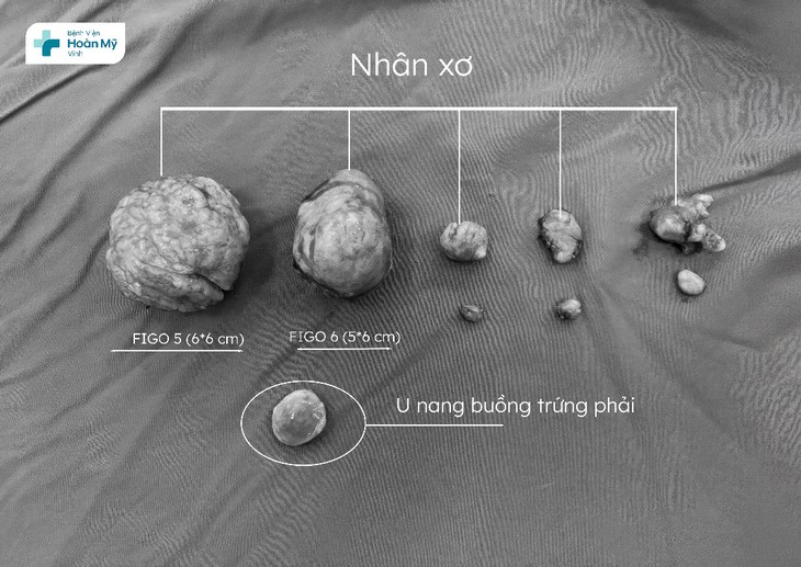 Bệnh viện Hoàn Mỹ Vinh điều trị thành công ca đa nhân xơ, giữ trọn tử cung cho người bệnh - Ảnh 2.