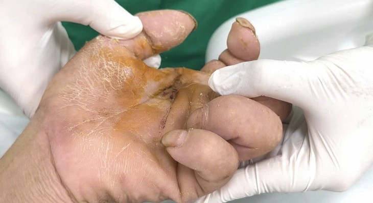 Gà mổ vào gót chân khiến cụ ông nguy kịch- Ảnh 1.