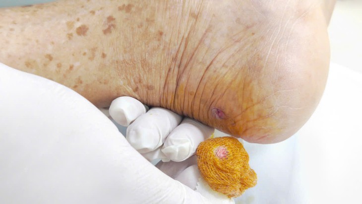 Gà mổ vào gót chân khiến cụ ông nguy kịch- Ảnh 2.