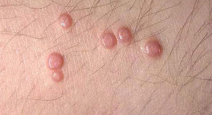 Con đường lây truyền mụn cóc sinh dục - Ảnh 1.
