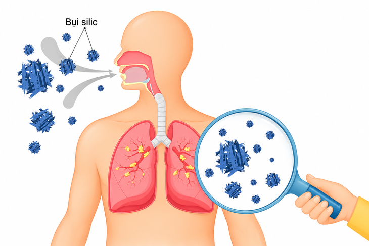 Bệnh nghề nghiệp thường âm thầm xuất hiện như thế nào? - Ảnh 1.