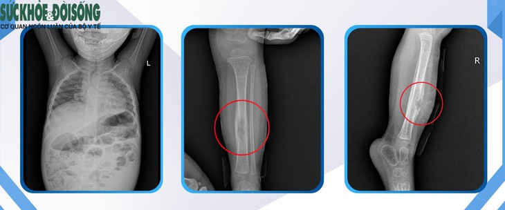 Bé gái hơn 3 tuổi mắc lao xương, bác sĩ cảnh báo các dấu hiệu nhận biết sớm- Ảnh 1.