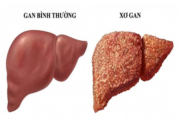 Ai có nguy cơ cao mắc bệnh xơ gan? - Ảnh 1.