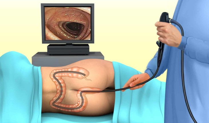 Trước và sau khi nội soi đại tràng cần lưu ý gì?- Ảnh 1.