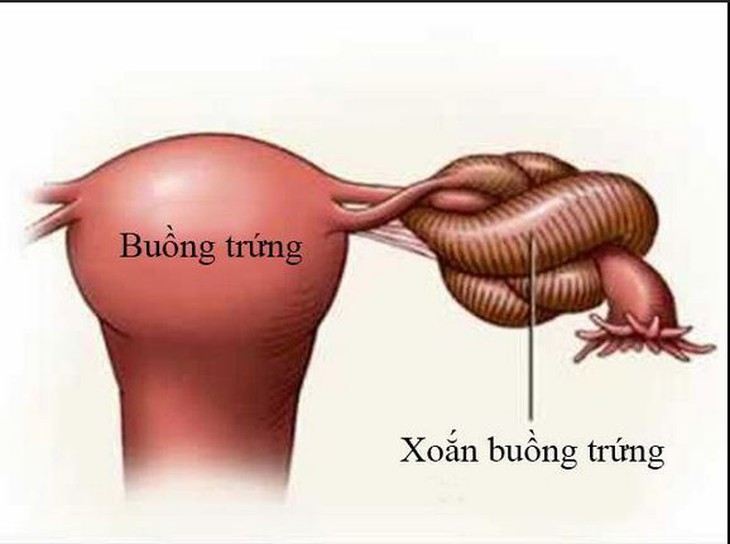 Đau bụng dữ dội, buồn nôn phát hiện xoắn u nang buồng trứng- Ảnh 1.