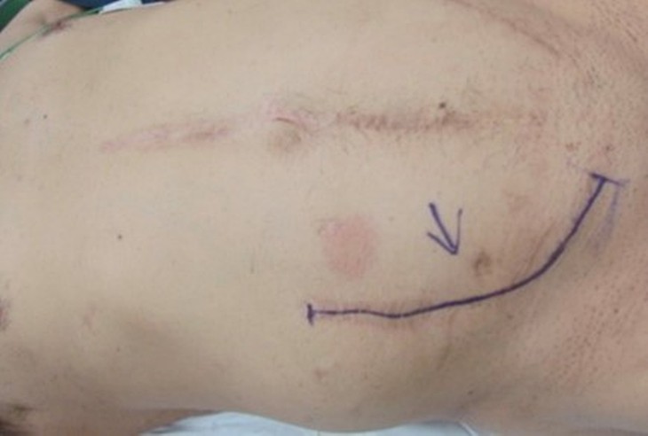 Ghép thận lần thứ 3 cho bệnh nhân có bất thường mạch máu, Bệnh viện Nhân dân 115 lập thêm dấu mốc chuyên môn- Ảnh 1.