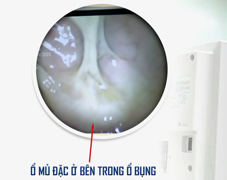Cứu kịp thời người phụ nữ vỡ áp xe phần phụ, mủ tràn ổ bụng gây viêm phúc mạc toàn thể- Ảnh 2.