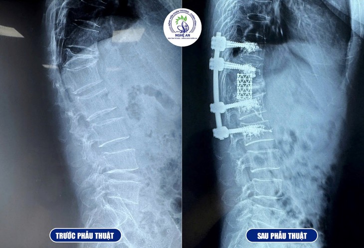 Lần đầu tiên triển khai thành công kỹ thuật thay thân đốt sống Titan tại Nghệ An- Ảnh 2.