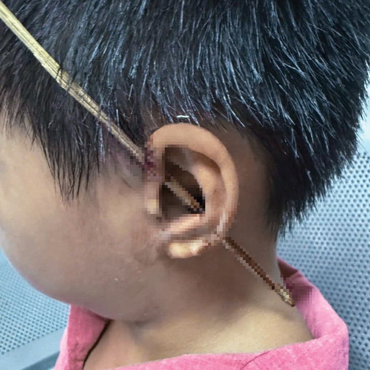 Que tre đâm xuyên vành tai bé trai 6 tuổi- Ảnh 1.