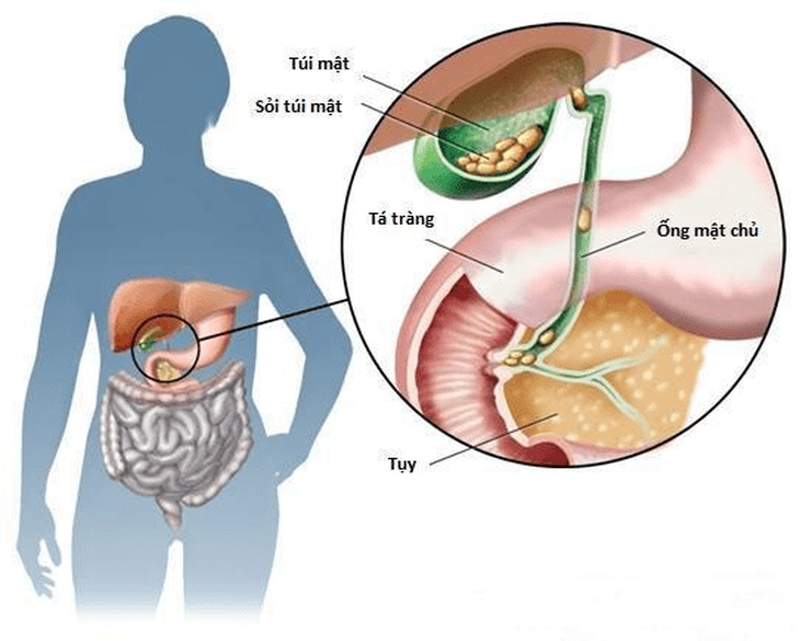 Sỏi ống mật chủ nguy hiểm ra sao nếu không được xử lý kịp thời?- Ảnh 1.