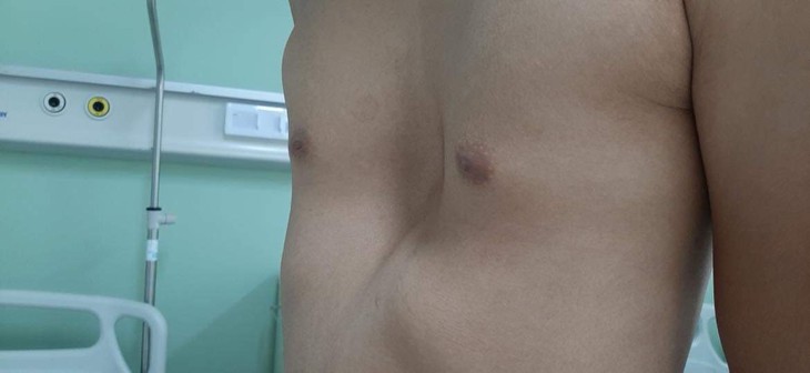 4 dấu hiệu phát hiện lõm ngực bẩm sinh ở trẻ- Ảnh 1.