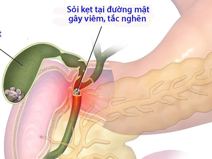 Sỏi ống mật chủ nguy hiểm ra sao nếu không được xử lý kịp thời?- Ảnh 3.