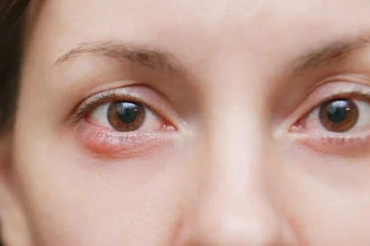 Ngứa rát, khô mắt kéo dài, cảnh giác với viêm bờ mi- Ảnh 1.