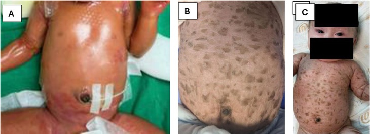 Vảy cá bẩm sinh: Bệnh da di truyền hiếm gặp cần được chăm sóc đúng cách - Ảnh 1.