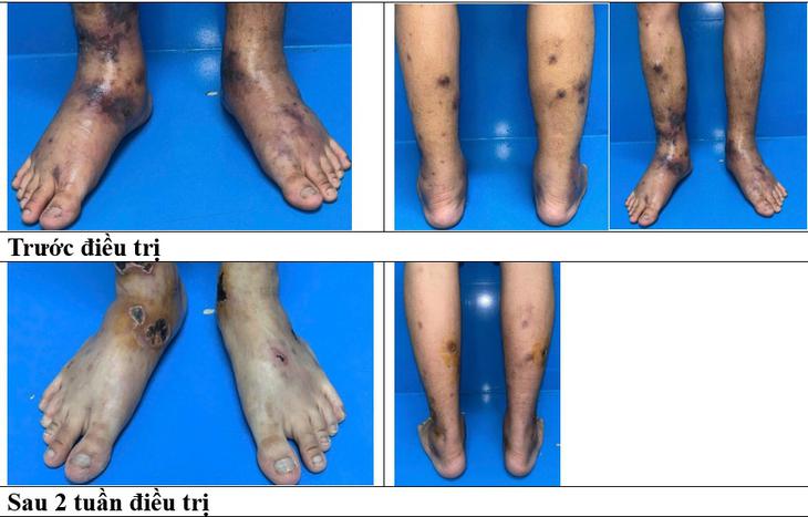 Cứu chữa thành công ca bệnh viêm mạch EGPA cực hiếm tại Việt Nam- Ảnh 1.