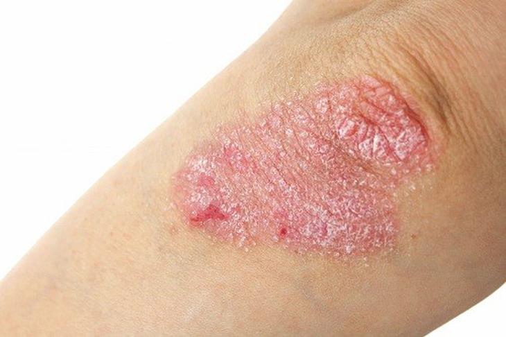 Cách chăm sóc người bệnh vảy nến để kiểm soát bệnh hiệu quả - Ảnh 1.
