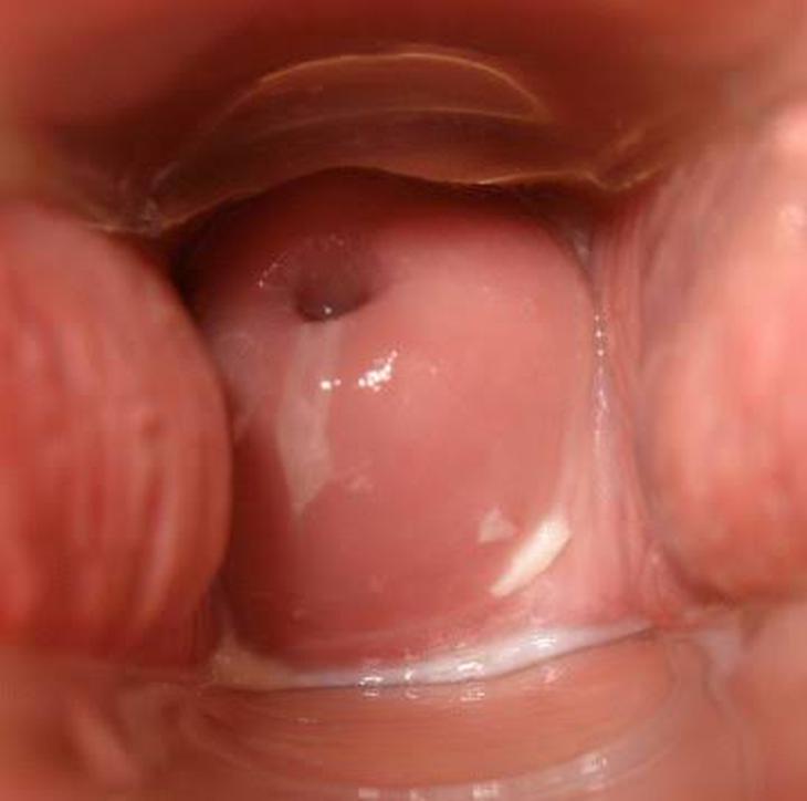 Lộ tuyến cổ tử cung có gây vô sinh không? - Ảnh 1.
