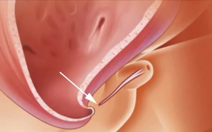 Lỗ tiểu thấp ở bé trai, có nên cắt bao quy đầu sớm?- Ảnh 1.