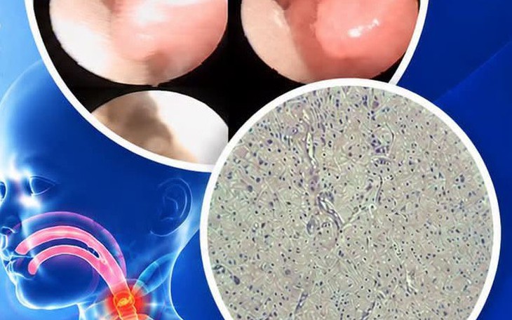 Nguy kịch vì viên thuốc mắc đường thở, bác sĩ mở khí quản ngay tại phòng bệnh- Ảnh 3.