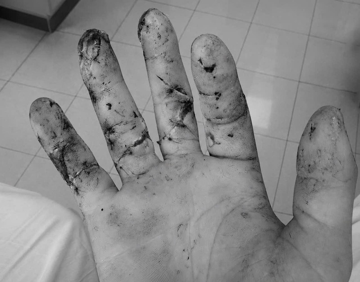 Ngày đầu đi làm, thanh niên 17 tuổi suýt mất 3 ngón tay vì máy cưa- Ảnh 2.