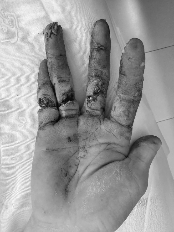 Ngày đầu đi làm, thanh niên 17 tuổi suýt mất 3 ngón tay vì máy cưa- Ảnh 1.