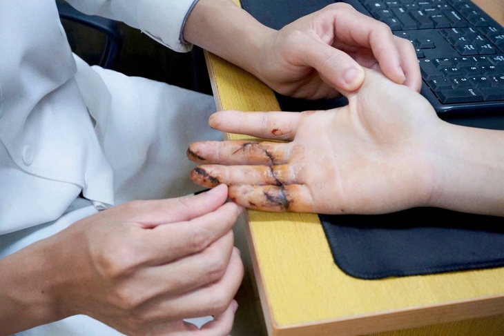 Ngày đầu đi làm, thanh niên 17 tuổi suýt mất 3 ngón tay vì máy cưa- Ảnh 3.