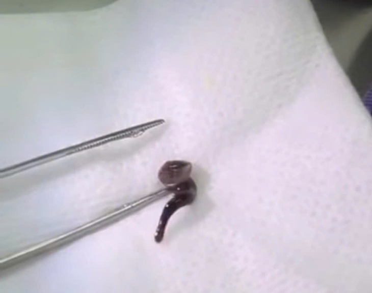 Uống nước ở suối, nam thanh niên bị con đỉa dài 2,5cm chui vào mũi - Ảnh 1.