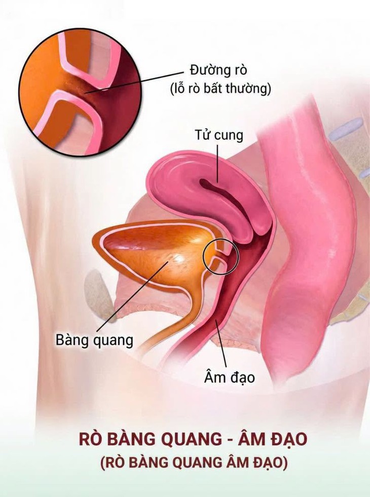 Chấm dứt 23 năm rò bàng quang - âm đạo nhờ phẫu thuật nội soi
- Ảnh 1.