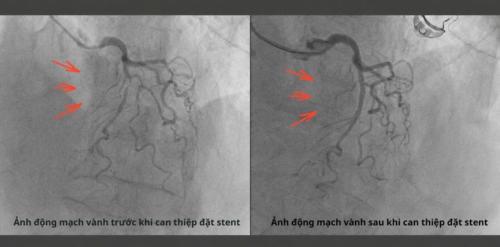 Cứu sống cụ bà 99 tuổi bị nhồi máu cơ tim cấp nhờ 'báo động đỏ' liên viện- Ảnh 1.