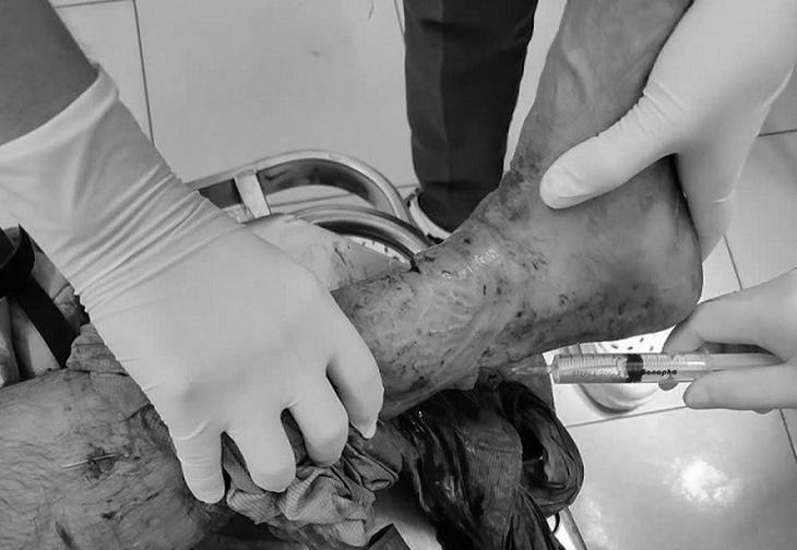 Lưỡi máy cắt cỏ ‘xé toạc’ cẳng chân, người đàn ông 64 tuổi đối mặt nguy cơ mất chi - Ảnh 1.