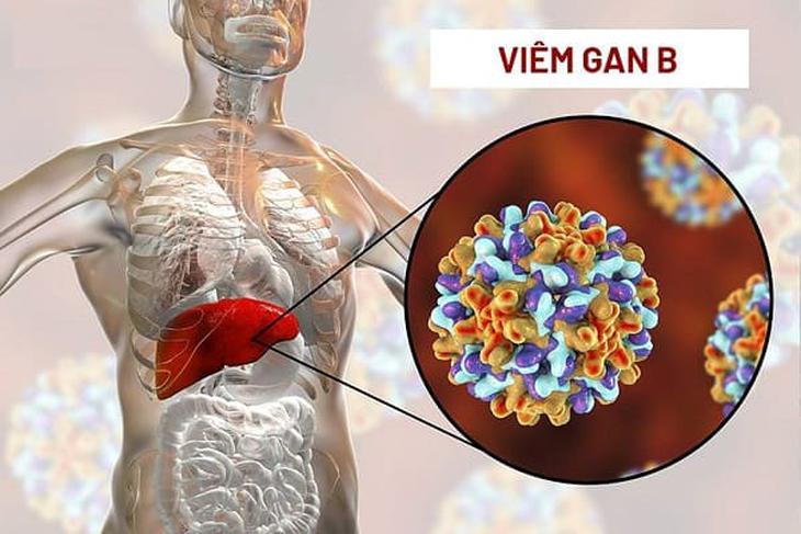 Viêm gan B cần kiêng gì để phòng biến chứng?- Ảnh 1.