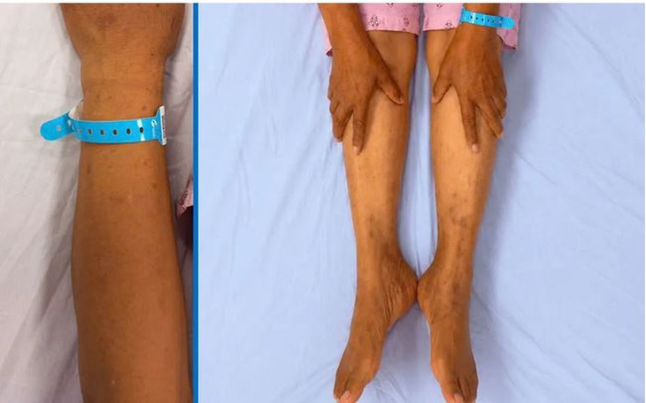 7 dấu hiệu tổn thương gan - Ảnh 1.