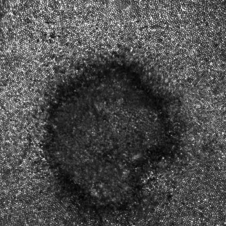Cô gái suốt đời thấy hình lưỡi liềm trong mắt chỉ sau vài giây xem nhật thực- Ảnh 2.