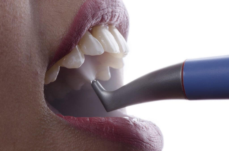 Lấy cao răng bằng hệ thống khí mu - Ảnh 1.