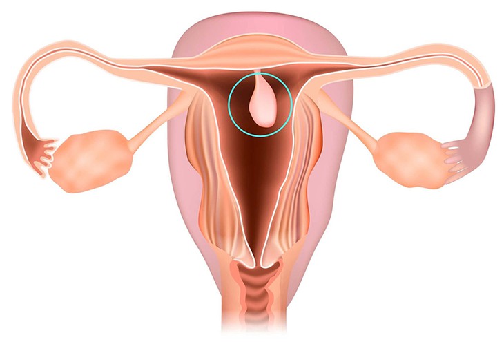 Polyp nội mạc tử cung có nguy hiểm không? - Ảnh 1.