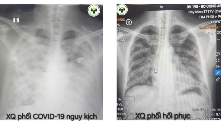 Nam bệnh nhân suy đa tạng, sốc nhiễm khuẩn do biến chứng nặng của COVID-19 - Ảnh 1.