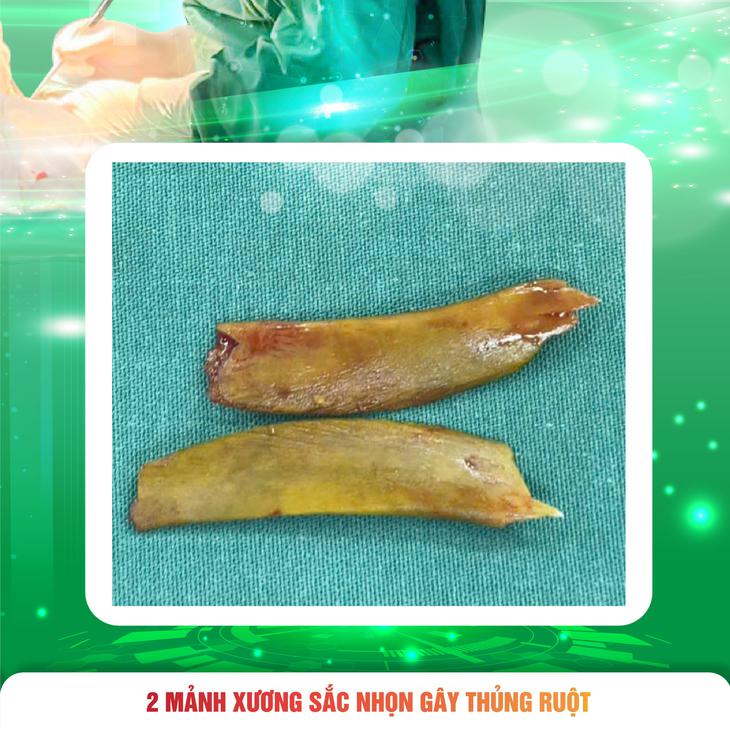 Người đàn ông hai lần thủng ruột vì cùng một nguyên nhân- Ảnh 3.