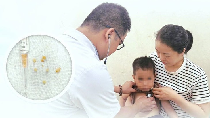 Cứu sống bé trai 2 tuổi hóc hạt lạc, bít kín hai bên phế quản- Ảnh 1.