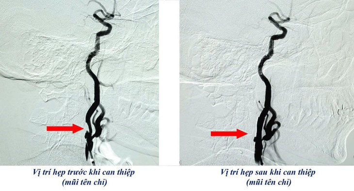 Can thiệp cứu cụ ông mắc 3 bệnh mạch máu nguy hiểm- Ảnh 2.