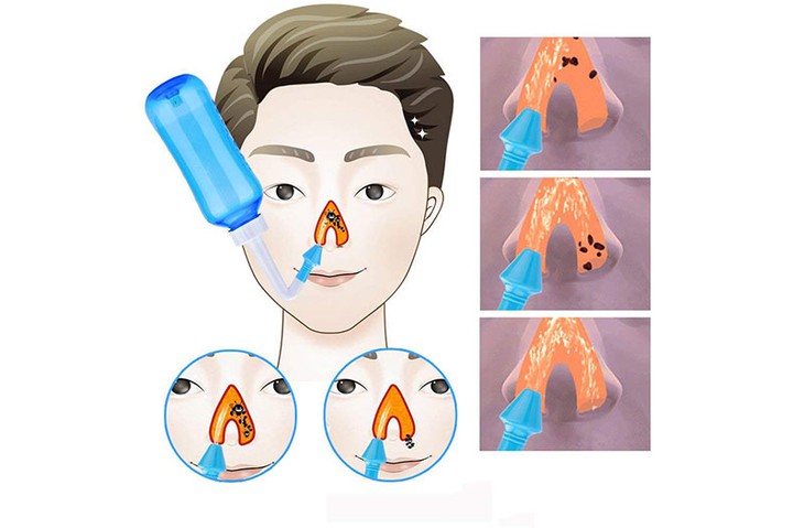 Vệ sinh mũi đúng cách- Ảnh 1.