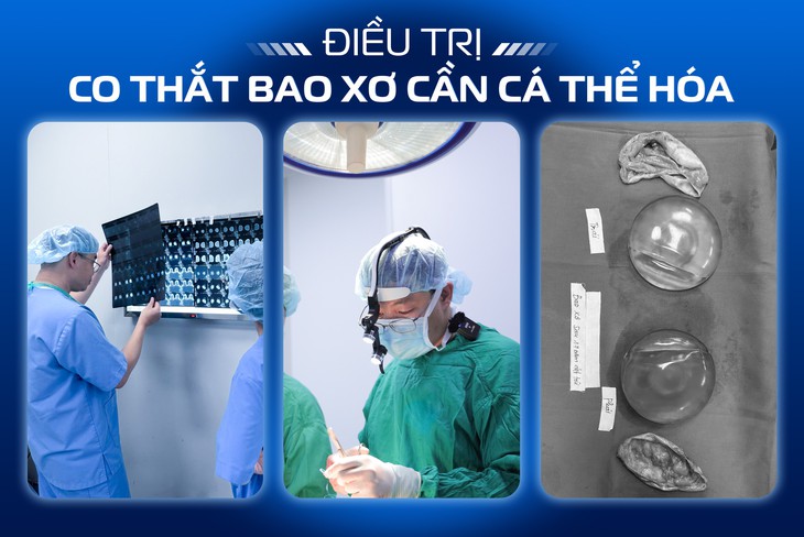 Đừng chủ quan với những dấu hiệu bao xơ khi nâng ngực- Ảnh 2.