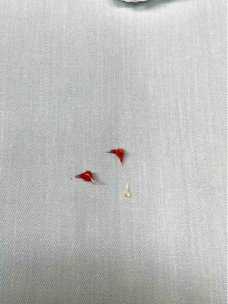 Lấy 3 mảnh xương lươn trong phế quản cho bé trai 7 tháng tuổi- Ảnh 1.