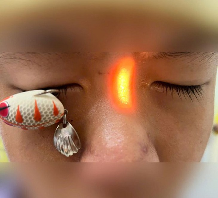 Móc câu xuyên thủng mắt, bé trai 13 tuổi nguy cơ ảnh hưởng thị lực lâu dài - Ảnh 1.