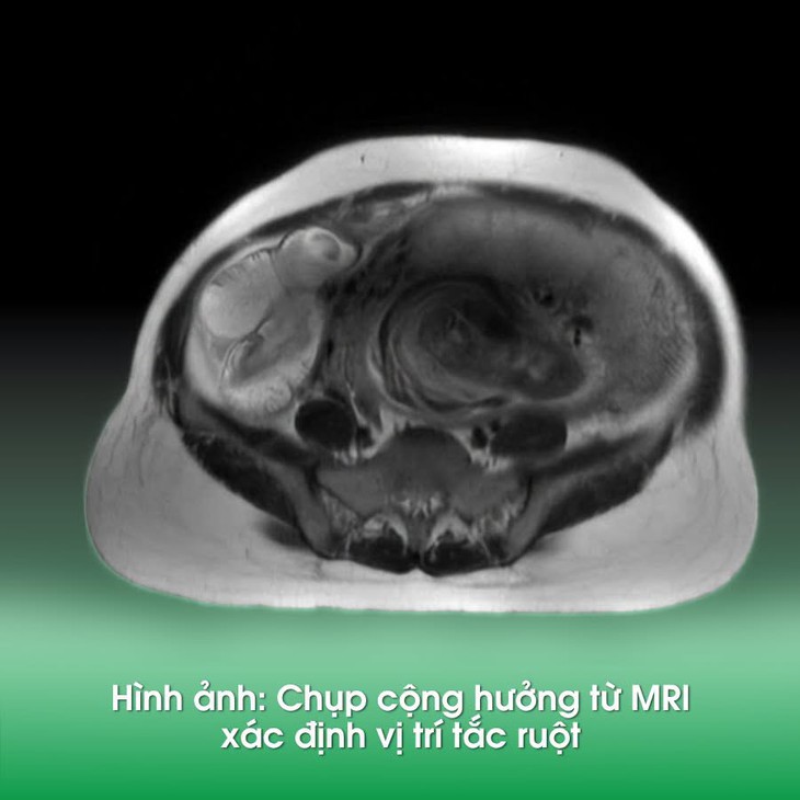 Thai phụ 35 tuần tắc ruột, cuộc phẫu thuật căng thẳng giữ an toàn cho bé- Ảnh 1.