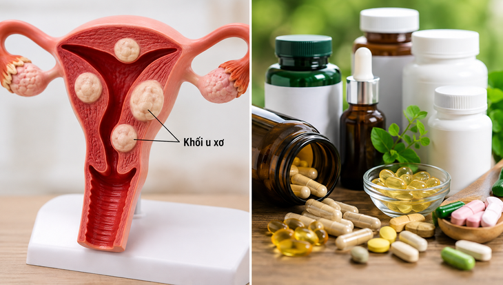 Những thực phẩm chức năng nào người bệnh u xơ tử cung nên tránh? - Ảnh 1.