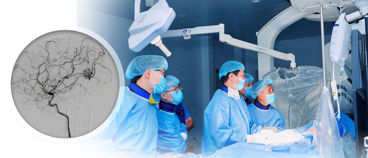 Hai trẻ vỡ dị dạng mạch máu não được can thiệp nội mạch thành công- Ảnh 1.