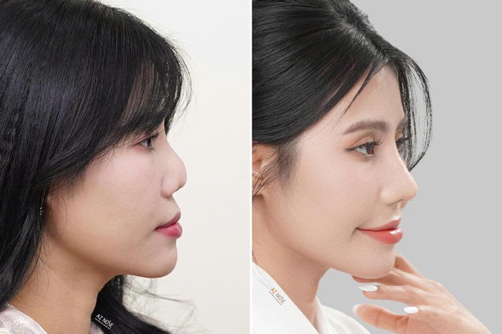 4 trường hợp thường được bác sĩ chỉ định nâng mũi cấu trúc- Ảnh 2.