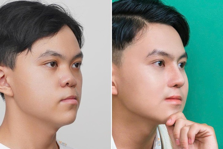 4 trường hợp thường được bác sĩ chỉ định nâng mũi cấu trúc- Ảnh 3.
