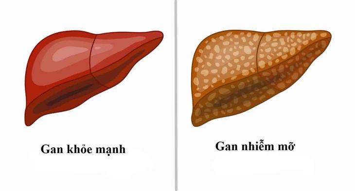 Gan nhiễm mỡ: Đừng kỳ vọng chỉ uống thuốc bổ gan là khỏi bệnh - Ảnh 1.