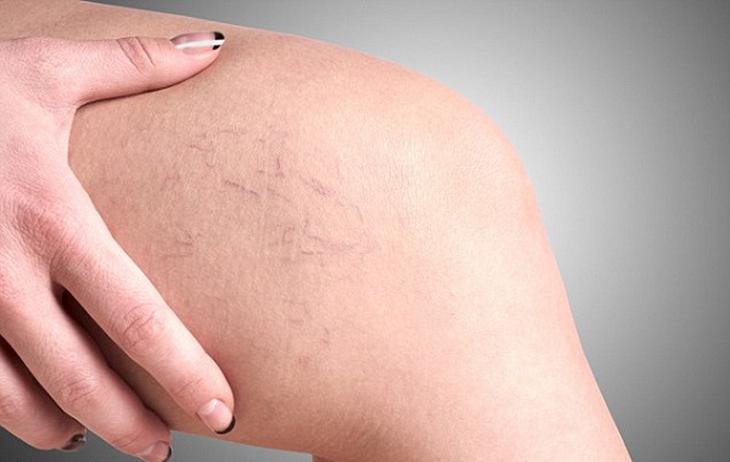 3 biến chứng nguy hiểm khi bị suy giãn tĩnh mạch chân- Ảnh 1.